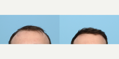25-34 year old man treated with FUE Hair Transplant, Hair Transplant, Hair Loss Treatment, PRP for Hair Loss, NeoGraft, Low-Leve - This 28-year-old patient was experiencing thinning hair in his crown area and a receding hairline. Due to his family history of hair loss, he wanted to take action as it was progressively worsening. To rebuild hairline and add density to the crown, Dr. Wise performed an FUE hair transplant using 2,515 grafts. During the procedure, the patient also underwent PRP therapy to strengthen the follicles and expedite healing.