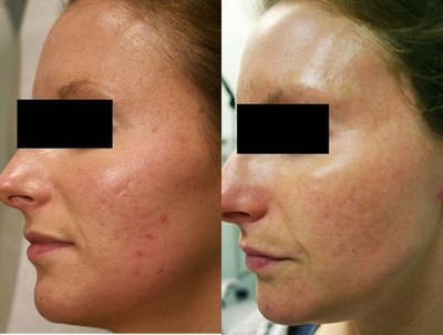 Affirm Laser - Affirm Laser