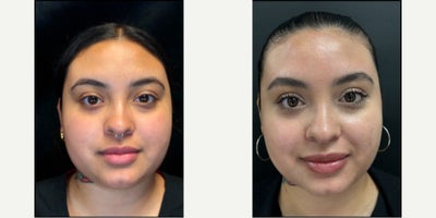 25-34 year old woman treated with Microneedling RF, Botox for Migraines - Treated with Evoke RF Remodeling and Botox for TMJ and Migraines. Treated by Aubrey Houchin, RN
