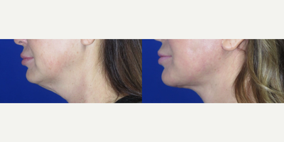 Woman treated with Nonsurgical Facelift, Nonsurgical Neck Lift - This patient wanted to refresh her appearance and came to us with concerns about the droopiness in her cheeks, sagging skin in her neckline, and jowls in her lower face.The FaceologyLIFT was performed to lift, tighten, and restore her lower face and neck. This procedure enhanced and revitalized her appearance while restoring her self-confidence.