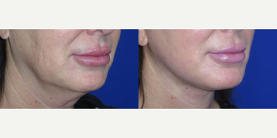 Woman treated with Nonsurgical Facelift, Nonsurgical Neck Lift - This patient wanted to refresh her appearance and came to us with concerns about the droopiness in her cheeks, sagging skin in her neckline, and jowls in her lower face.The FaceologyLIFT was performed to lift, tighten, and restore her lower face and neck. This procedure enhanced and revitalized her appearance while restoring her self-confidence.