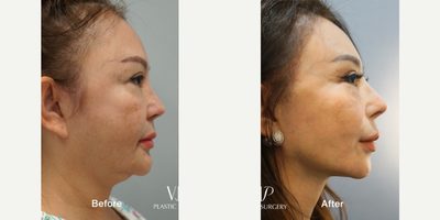 55-64 year old woman treated with Asian Rhinoplasty, Rhinoplasty, Revision Rhinoplasty, Facelift, Deep Plane Facelift, SMAS Face - 2 year post operative surgery before and after for 60-year-old female patientSurgery List:Extended deep plane faceliftNecklift, Middle neck plicationRib cartilage rhinoplasty, Mid face augmentationEndoscopic forehead & brow liftFull face fat graftingStem cell treatmentPerformed by VIP Plastic Surgery chief surgeon, Dr. Myung Ju Lee