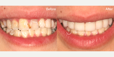 35-44 year old woman treated with Full Mouth Reconstruction - 40-year-old woman treated with Full Mouth Reconstruction