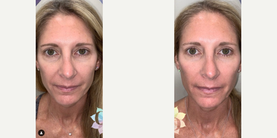 Woman treated with Vivace - Notice how much tighter and smoother her skin is! This patient is loving her skin even more now than she did in her 20s. We used Radiesse filler in the temples, tear troughs, cheeks, and around the mouth. We also did Vivace which is our go-to skin-tightening treatment! It uses radio frequency combined with microneedling.