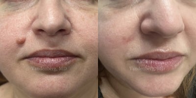 35-44 year old woman treated with Mole Removal - Amazing results at 7 weeks post-mole removal. At this stage, the skin has healed and mild redness or firmness is normal as the scar continues to mature. Over the next several months, the area will continue to soften and fade as part of the natural healing process.