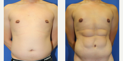 35-44 year old man treated with Vaser Liposuction - Introducing our remarkable patient, a mid 30s male who embarked on a transformative weight loss journey. He dedicated himself to a healthy lifestyle and successfully shed 20 pounds. However, he desired further enhancement for his abdomen, aiming for a sculpted 6-pack appearance in his abdomen.Driven by his aspirations, he traveled to Beverly Hills, CA, to seek the expertise of Dr. J. Timothy Katzen. Under Dr. Katzen's exceptional care, the patient underwent a procedure known as VASER Hi-Def of the abdomen.The surgical intervention proved highly successful, as evidenced by the post-surgery images revealing a more toned and defined abdomen. The patient expressed great satisfaction with the results, highlighting the positive impact on his confidence and self-image.We find it inspiring to witness how cosmetic procedures can assist individuals in achieving their desired appearance and boosting their sense of confidence. We wish our patient continued health and happiness, and we encourage him to maintain his healthy habits to ensure long-lasting results.Please note that individual experiences may vary, and the outcome described here may not reflect the experiences of others.