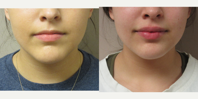 Lip Augmentation with fillers - Patient is 19 years old and wanted to have fuller looking lips. One syringe of Juvederm was injected in both her upper and lower lips giving her a beautiful result.
