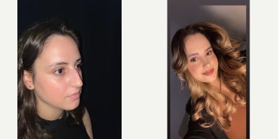 25-34 year old woman treated with Rhinoplasty - Natural, slightly curvy female nose that perfectly fits the patients facial features and creates a harmonious appearance from every angle.