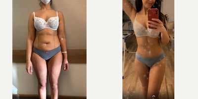 25-34 year old woman treated with Lipo 360, Renuvion - 25-34 year old woman treated with Lipo 360, Renuvion. Also had liposuction and Renuvion for arms and thighs.