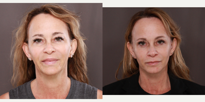 45-54 year old woman treated with MACS Facelift, Eyelid Surgery - Macslift, Upper & Lower Blepharoplasty