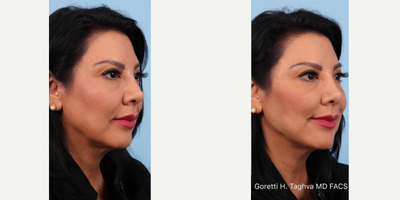55-64 year old woman treated with Liquid Facelift using Bellafil - Nonsurgical, liquid face lifting using 4 syringes of Bellafil; result is immediate, natural and long lasting with minimal downtime.