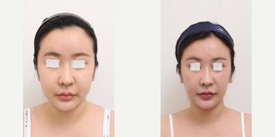 25-34 year old woman treated with AccuLift, Laser Liposuction, Liposuction - 28 Years old female patient Chief Complain: - over injected forehead (fat graft 3 years ago in X clinic) - double chin & overall facial fat Treatment Plan: full face liposuction /forehead reconstruction by liposuctionOutcome: - forehead liposuction pure fat: 20cc- double chin liposuction pure fat: 50- face liposuction pure fat : 124cc (cheek side, front, near ears, zygomatical angle)