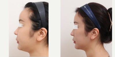 25-34 year old woman treated with AccuLift, Laser Liposuction, Liposuction - 28 Years old female patient Chief Complain: - over injected forehead (fat graft 3 years ago in X clinic) - double chin & overall facial fat Treatment Plan: full face liposuction /forehead reconstruction by liposuctionOutcome: - forehead liposuction pure fat: 20cc- double chin liposuction pure fat: 50- face liposuction pure fat : 124cc (cheek side, front, near ears, zygomatical angle)