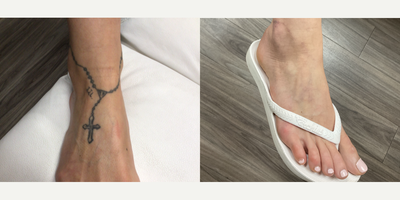 35-44 year old woman treated with Tattoo Removal - This 36-year-old patient wanted to remove her tattoos. To do so, 12 sessions of PicoWay were performed. Her after photos are shown 3 months after her 11th session.