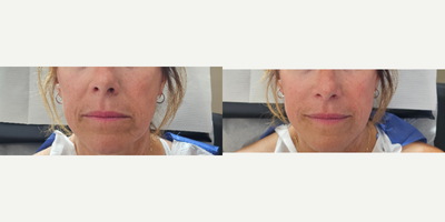 45-54 year old woman treated with Restylane Defyne, Restylane, Dermal Fillers - This patient was treated with 1cc of Restylane Defyne in the Nasolabial Folds/Laugh-Lines. The smoothing between the cheek and peri-oral area creates a more youthful appearance and a rejuvenated look.