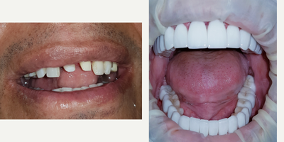 45-54 year old man treated with BriteSmile - Porcelain crowns . Porcelain veneers