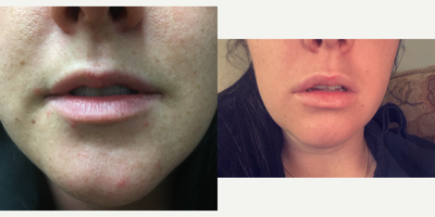 25-34 year old woman treated with Lip Implants - PermaLip silicone lip implants upper and lower lips for volume and shape enhancement.