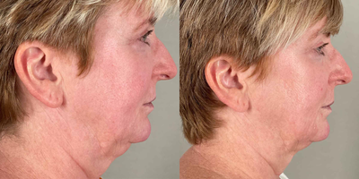 61 year old woman treated with Ellacor - Ellacor assisted this patient in skin laxity and sagging skin on her neck!