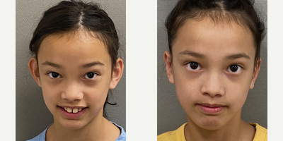 17 or under year old woman treated with Ear Surgery - 11 yo s/p otoplasty  performed under local anesthesia only in our on site AAAA certified operating suite.