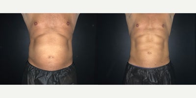 45-54 year old man treated with CoolTone - 2 months 6 CoolTone treatments