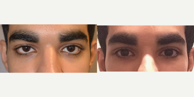 Almond Eye Surgery and Tear Trough Implant in young patient with inherited lower eyelid retraction. - Almond Eye Surgery (lower eyelid retraction surgery with canthoplasty, internal spacer graft) plus lower orbital rim implant (tear trough implant) in a young male patient with inherited lower eyelid retraction and sclera show.