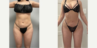 Woman treated with Rib Remodeling - Woman treated with Rib Remodeling