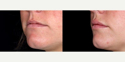 29year old woman treated with Volbella - 29year old woman treated with Volbella, Lip Fillers. Photos depict before and 2 weeks after treatment.