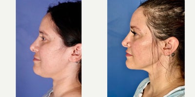25-34 year old woman treated with FaceTite - Facetite with Liposuction of Lower Face
