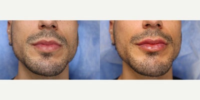25-34 year old man treated with Lip Fillers, Belotero, Restylane Kysse, Dermal Fillers - Men can have lip filler too!