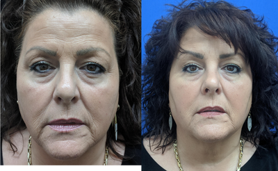 55-64 year old woman treated with Collagen Injection - Platelet rich plasma injections for facial rejuvenation.