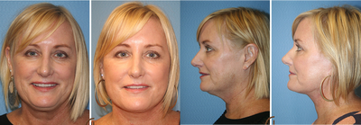 Lower Facelift and Neck Lift with Fat Grafting to the face for Natural Looking Results  - This patient is 8 weeks post surgery of a mini facelift, focusing on her lower face and neck. She desired a procedure that would refresh her facial features without major surgery and included a quick recovery. After a complete evaluation during her cosmetic consultation with board certified facial plastic surgeon Dr. Kevin Sadati a lower facelift, neck lift and fat grafting was recommend to obtain optimal results.&nbsp;The procedure was performed as an out-patient procedure setting using twilight sedation and local anesthesia. In this cosmetic surgery procedure muscle tightening was performed on loose facial and neck muscles &nbsp;while excess skin was removed to improve skin laxity. Next excess fatty tissue was obtained from liposuction then injected into the patient's face as a natural filler. Dr. Kevin Sadati injects the fat grafting to the desired areas of the face then sculpts the tissue to get the perfect results. Her recovery was quick and she returned to her busy lifestyle in short period of time. No general anesthesia was used.&nbsp;
