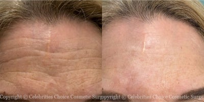 Woman treated with Scar Removal - Woman treated with Scar Removal