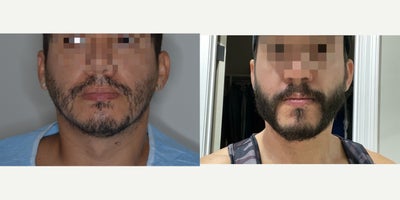 Male patient treated with 1800 FUE Beard Transplant - 8 months post-op from 1800 FUE grafts.