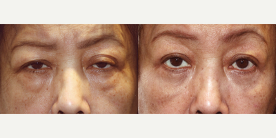 48 year old woman treated with Ptosis and Blepharoplasty Surgery - 48 year old woman treated with both Ptosis and Blepharoplasty Surgery, correcting puffiness and droopy eyelids thus giving the face a more youthful appearance.