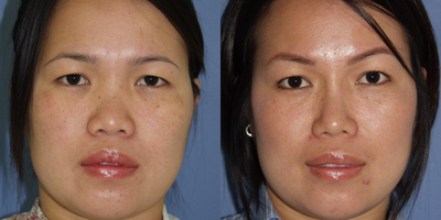 25-34 year old woman treated with Asian Rhinoplasty - 2 years following all natural Asian rhinoplasty with augmentation of dorsum and nasal tip with cartilage grafts from rib (no artificial implants)