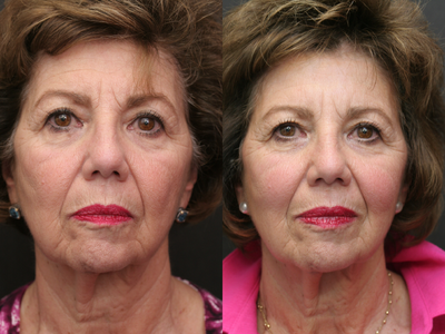 Pelleve - Pellev is a painless, non-invasive, 1 hour office procedure with no downtime done by our aestheticians. Results range from subtle to dramatic depending on the patients own ability to make new collagen, which can be age-related. This is a 68 year old young lady who had a very significant increase in midface volume and some smoothing of her chin and the area around her mouth after her initial series of 4 treatments.