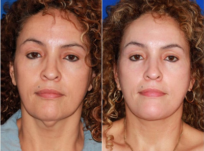 Woman treated with Facelift Revision - This patient recently underwent a facelift with another doctor. However, she was dissatisfied with the lack of improvement in the neck. Secondary face and neck lift was performed to restore youthful neck contour.