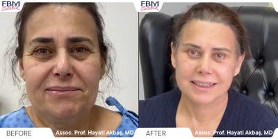 45-54 year old woman treated with SMAS Facelift, Eyelid Surgery - 45-54 year old woman treated with SMAS Facelift, Eyelid Surgery