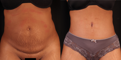 35-44 year old woman treated with Belly Button Surgery, Liposuction, Tummy Tuck, Tumescent Liposuction - Beautiful results from a recent patient's Tummy Tuck surgery with Dr. Leverett. She also had an umbilical hernia repair and liposuction to the flanks. Have you scheduled your consultation with Dr. Leverett to discuss your goals yet? We look forward to working with you!