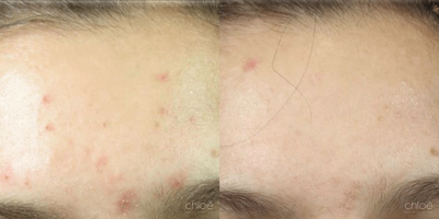 Face Age Spots Treatment using Chemical Peel - Solar lentigos, commonly called dark spots or age spots, are flat brown spots caused by sun exposure. They may be present all over the body surface, especially in the areas most exposed to UV rays. This condition can be effectively treated with chemical peels.