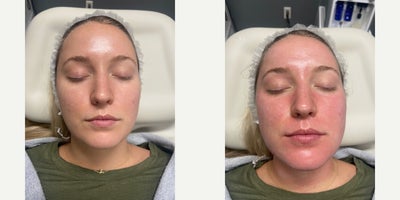 25-34 year old woman treated with DiamondGlow - This patient was treated with DiamondGlow. These photos are immediately post procedure.