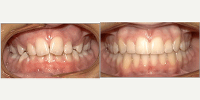 55-64 year old man treated with Damon Braces - Damon Braces Treatment
