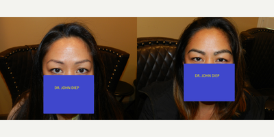 18-24 year old woman treated with Eyebrow Transplant - 18-24 year old woman treated with Eyebrow Transplant