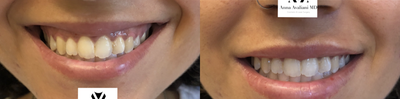 25-34 year old woman treated with Botox, Botox for Gummy Smile - Gummy smile correction with botox