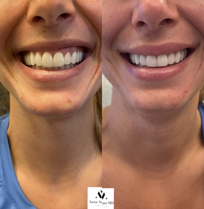 18-24 year old woman treated with Botox for Gummy Smile, Botox - Gummy smile correction with botox