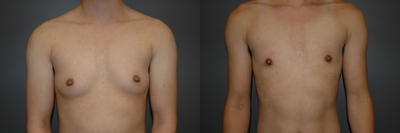 FTM. Bilateral perioareolar mastectomies, (hidden incision around nipple) - FTM. Bilateral perioareolar mastectomies, (hidden incision around nipple)