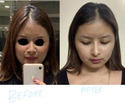 Face Ruined By Dr Monisha Kapoor Review Realself Sonam kapoor very funny moment with husband anand ahuja. face ruined by dr monisha kapoor