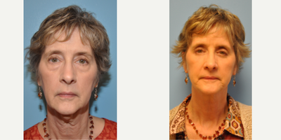 55-64 year old woman treated with Eyelid Surgery, ThermiTight - 62 year old female underwent Upper and Lower Blepharoplasty and Thermitight under general anesthesia.