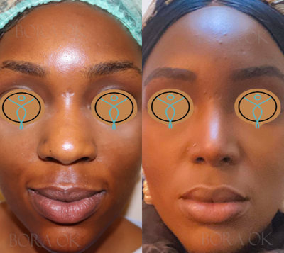 25-34 year old woman treated with African American Rhinoplasty - 25-34 year old woman treated with African American Rhinoplasty