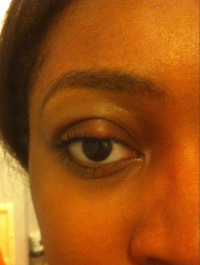 Is there any way to get rid of this chalazion/ scar tissue ...